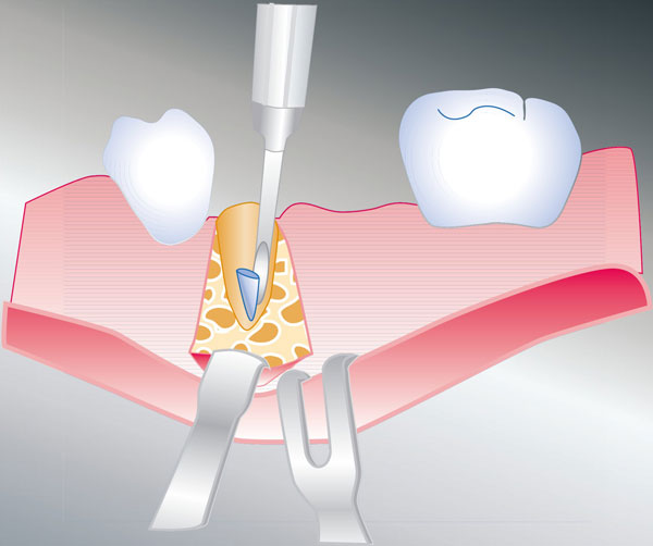 Osteotomie